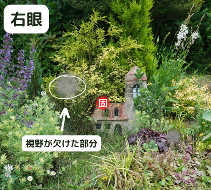 緑内障について02