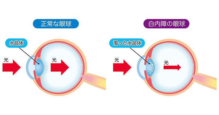 白内障