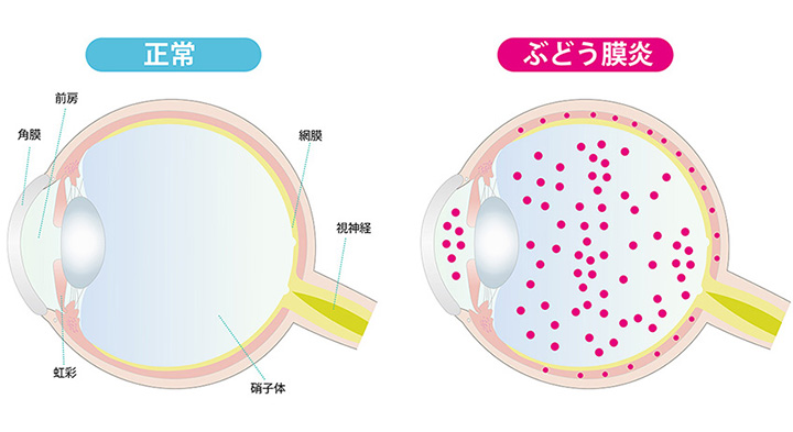 ぶどう膜炎
